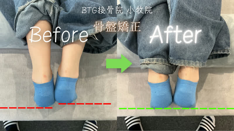 姿勢矯正のビフォーアフター 症例10