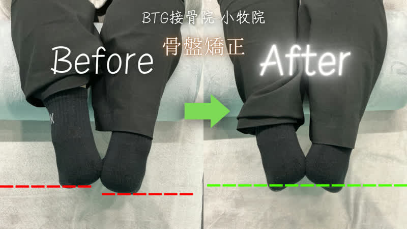 姿勢矯正のビフォーアフター 症例11