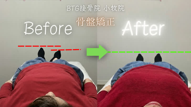 姿勢矯正のビフォーアフター 症例12