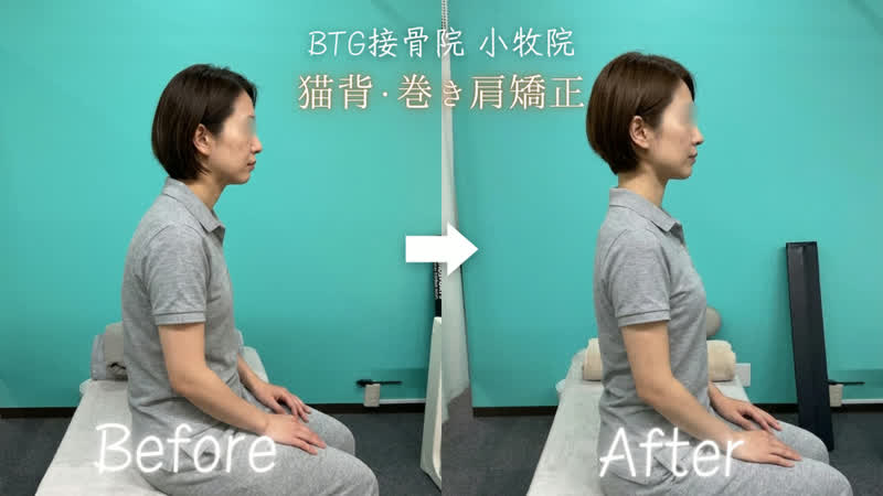 姿勢矯正のビフォーアフター 症例2