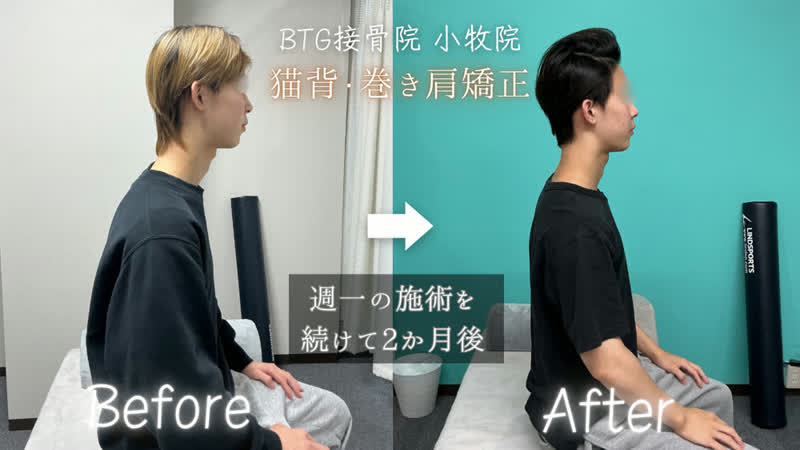 姿勢矯正のビフォーアフター 症例3
