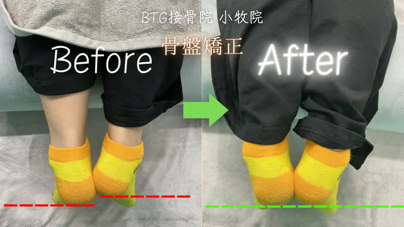 姿勢矯正のビフォーアフター 症例7
