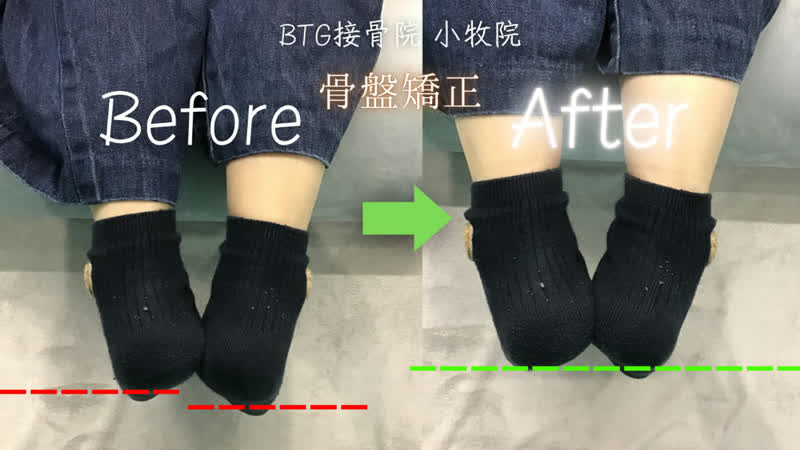姿勢矯正のビフォーアフター 症例9
